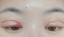 双眼皮埋线视频全过程,从术前准备到术后恢复